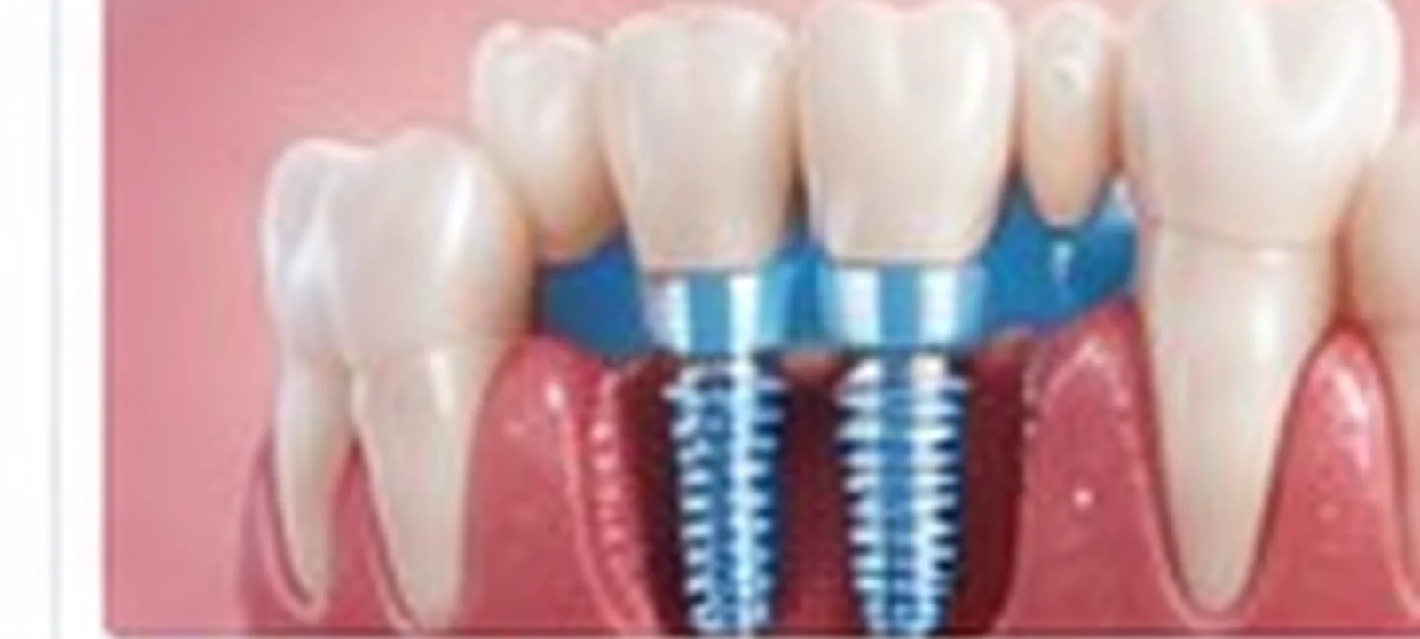 All-on-4 / full-arch implants (per arch) | Hospitals of India